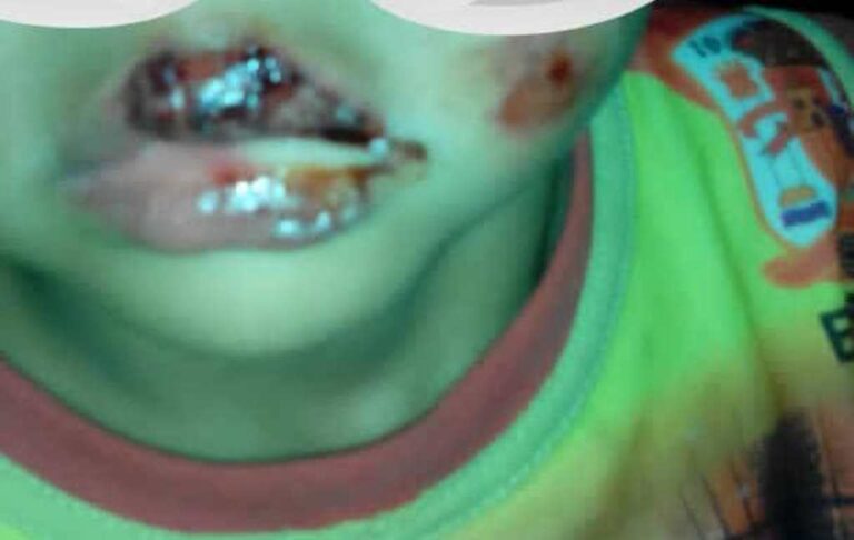 Mujer quemó a su hijo de 3 años por comerse una mortadela